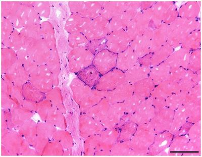 Acute Respiratory Failure Is the Initial Manifestation in the Adult-Onset A3243G tRNALeu mtDNA Mutation: A Case Report and the Literature Review